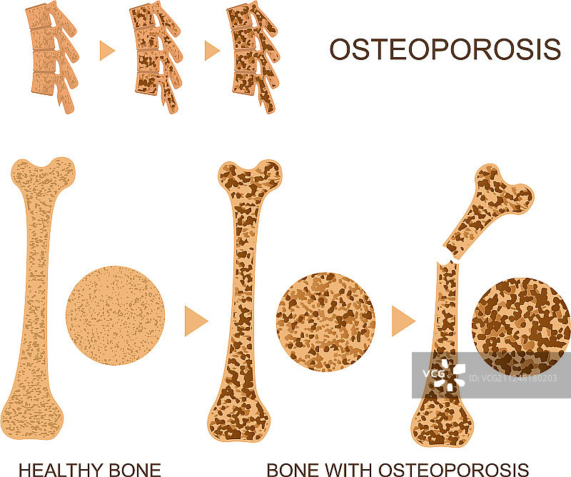 骨质疏松症信息图概念海报图片素材