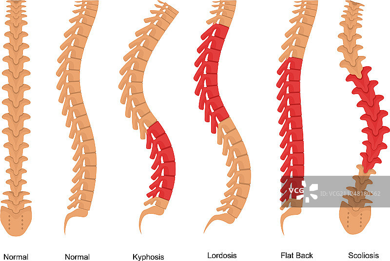骨质疏松症骨骼类型信息图概念卡图片素材
