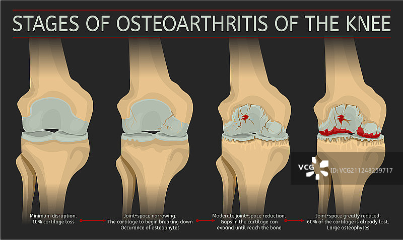 膝关节骨关节炎分期图片素材