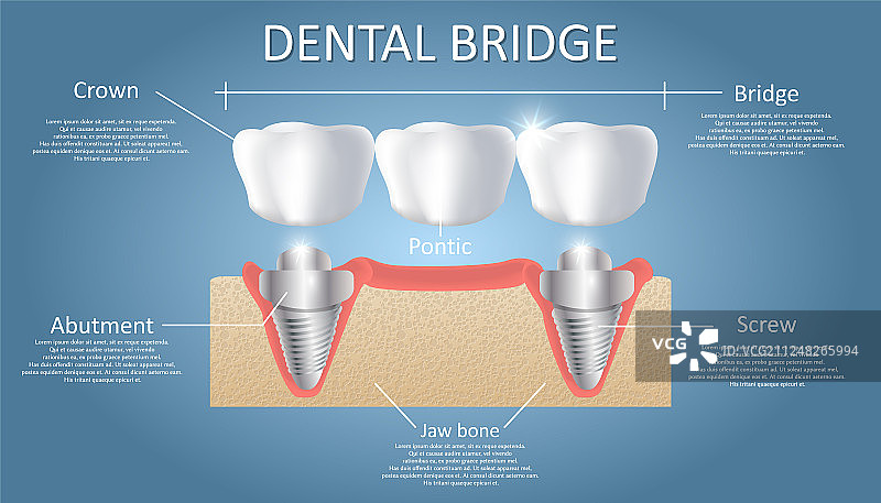 牙桥概念教育海报图片素材