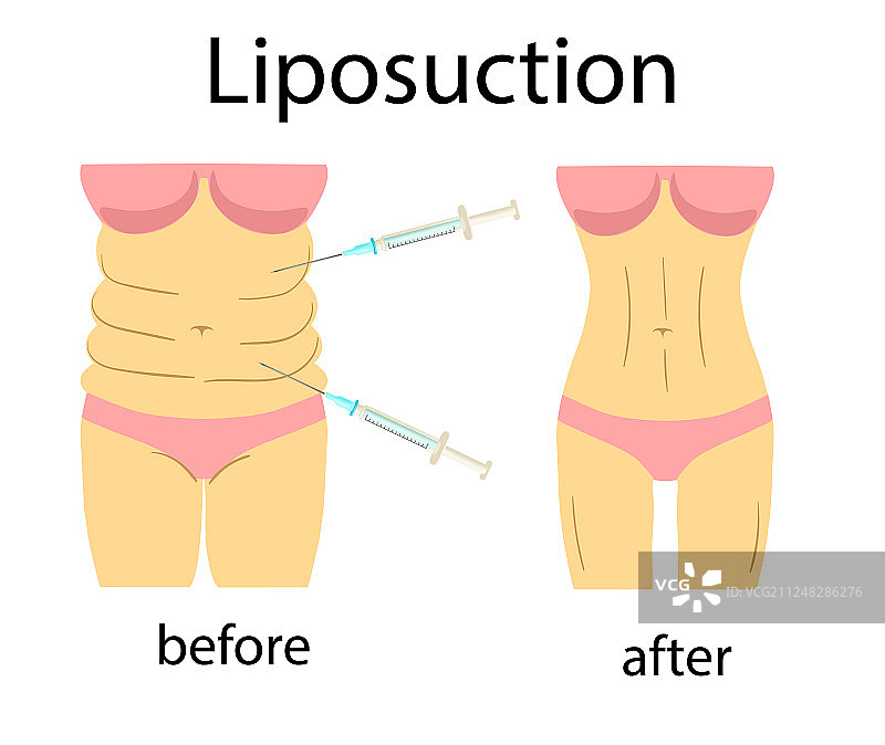 抽脂前后效果健身图图片素材