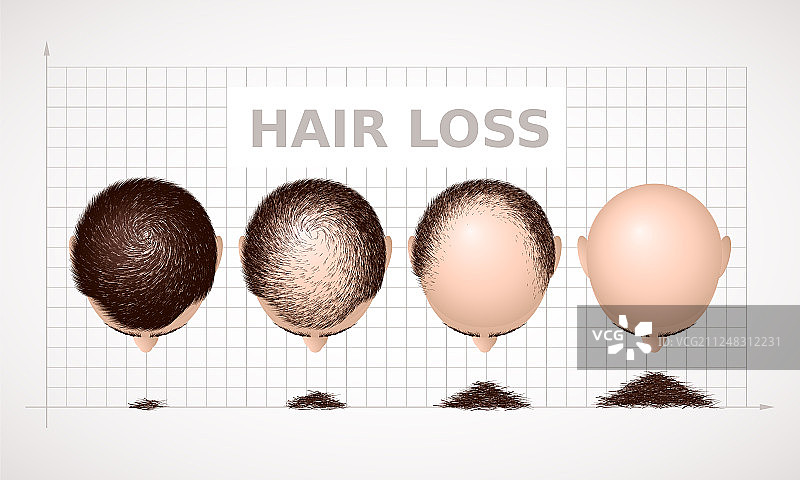 四个阶段脱发示意图图片素材