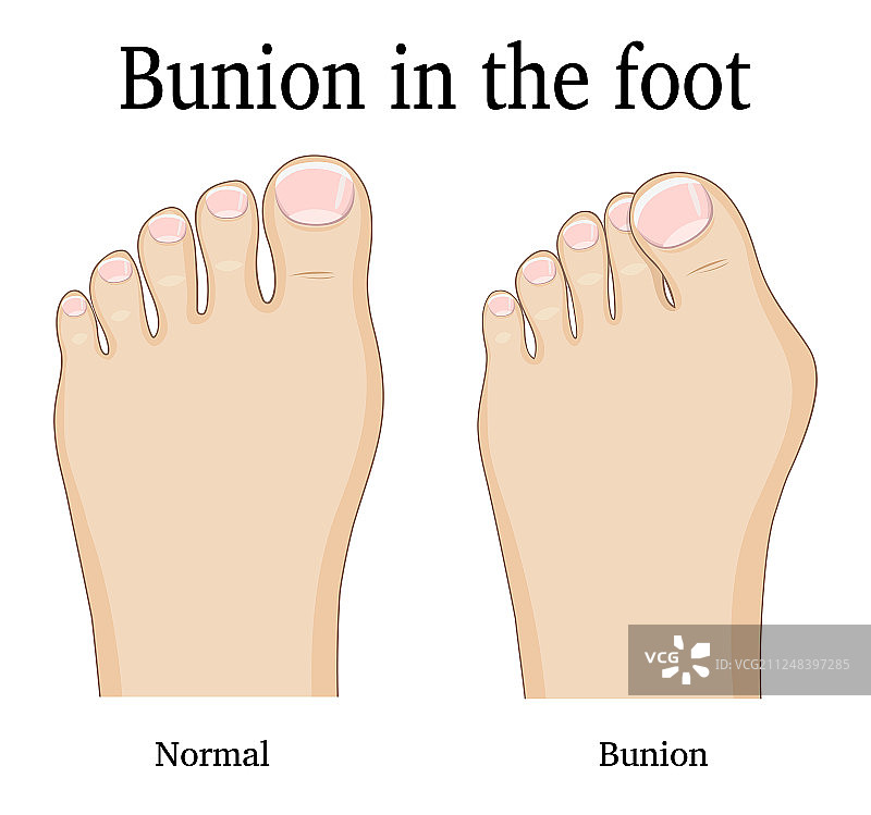 足部拇囊炎图片素材