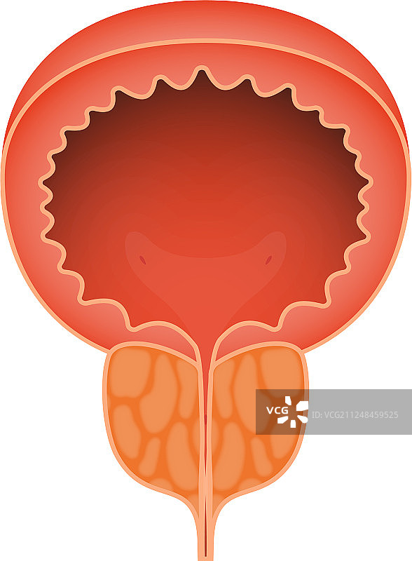 白色背景上的急性前列腺炎图片素材