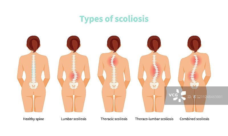 脊柱侧弯类型图片素材