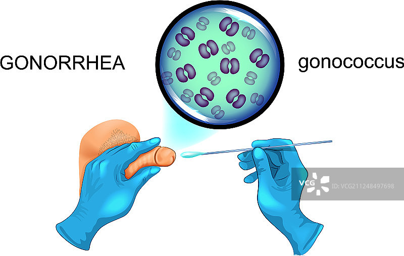 淋病的阴茎拭子图片素材