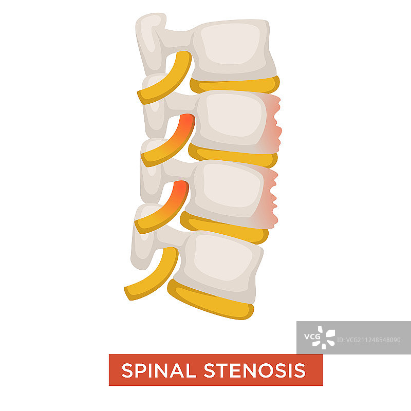 椎管狭窄脊柱疾病或椎骨疾病图片素材