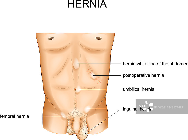 疝气位置类型图片素材