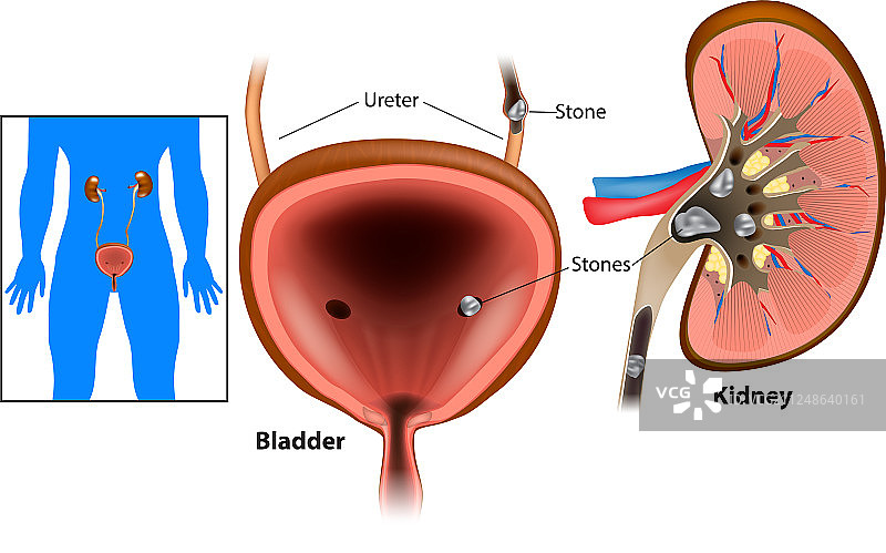 肾结石疾病图片素材