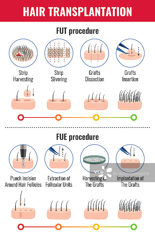 头发移植信息图图片素材