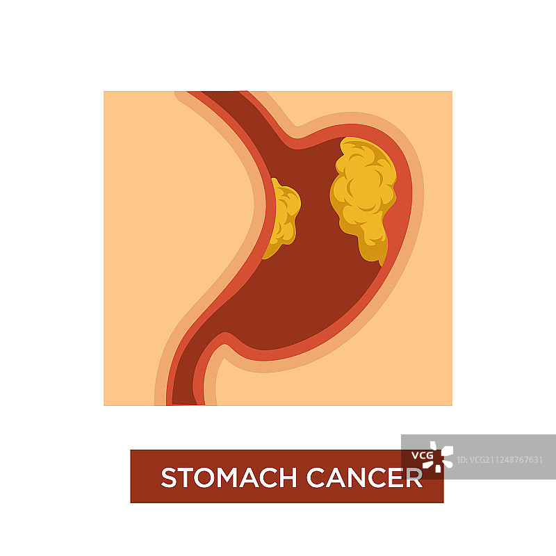 胃癌症状肿瘤学疾病图片素材