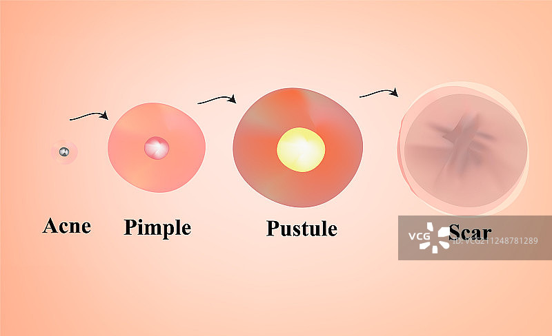 黑头粉刺痤疮疤痕皮肤类型图片素材