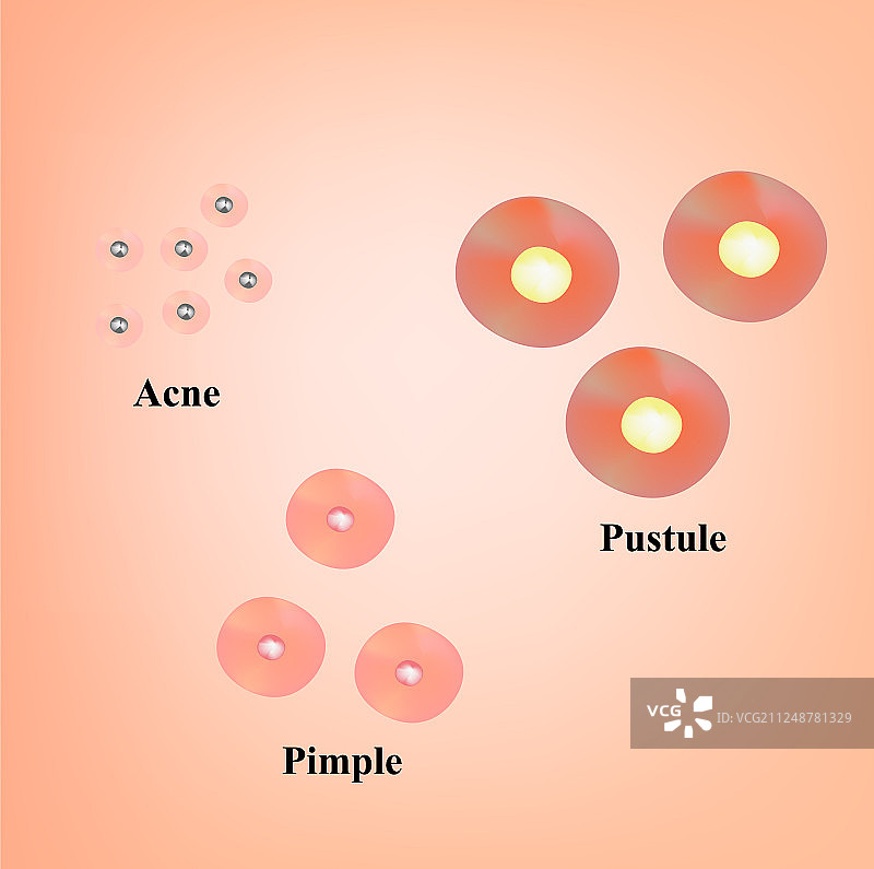 黑头粉刺痤疮疤痕皮肤类型图片素材