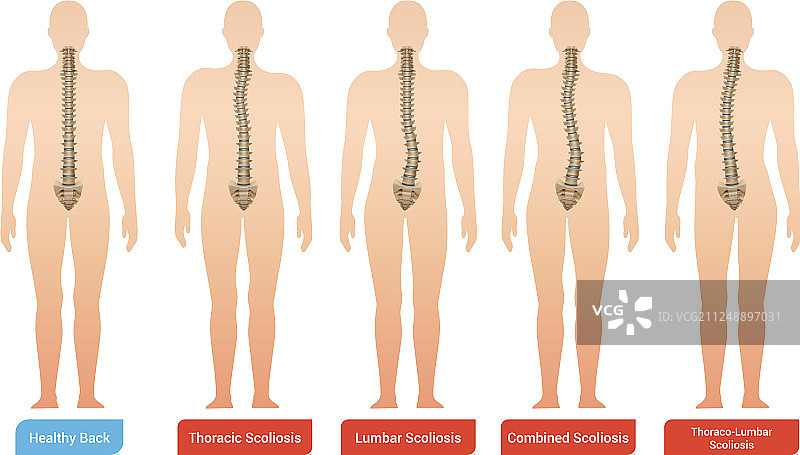 脊柱弯曲信息图集图片素材