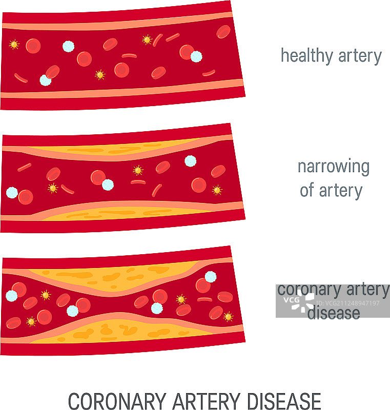 扁平风格的心脏动脉疾病概念图片素材