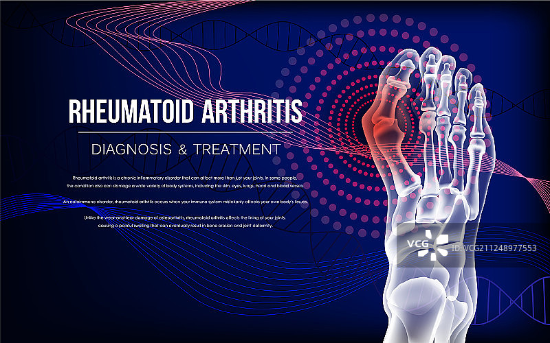 类风湿性关节炎足部骨骼图片素材