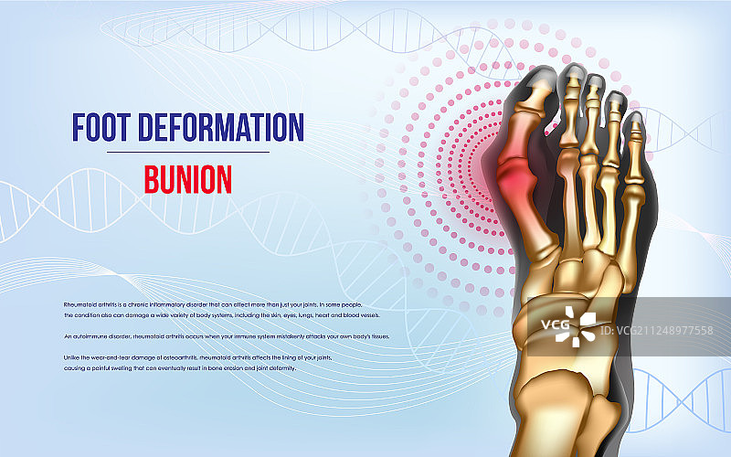 足部畸形拇囊炎图片素材