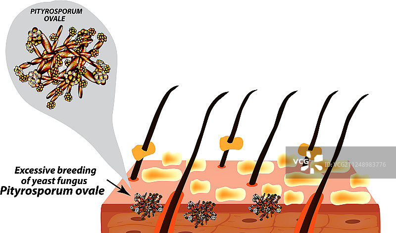 糠秕孢子菌病图片素材