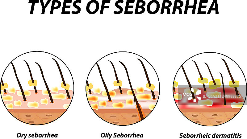 皮脂溢性皮肤和头发类型图片素材