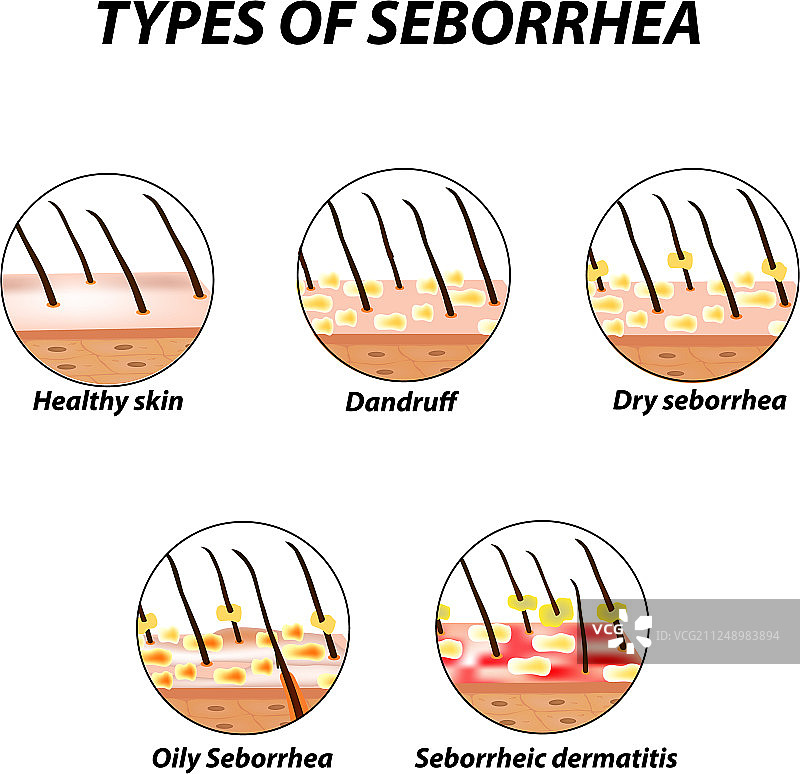 皮脂溢性皮肤和头发类型图片素材