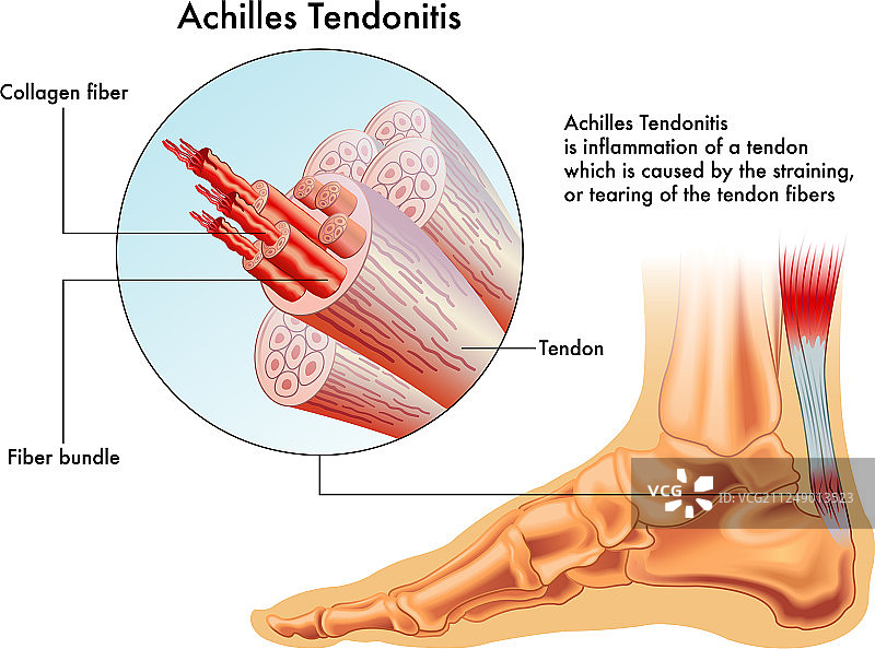 跟腱炎图片素材