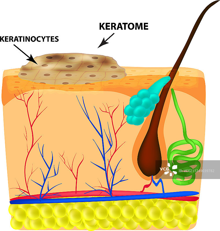 角化瘤结构图片素材
