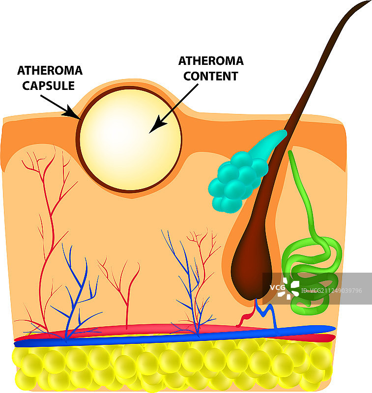 动脉粥样瘤结构，痣的结构图片素材