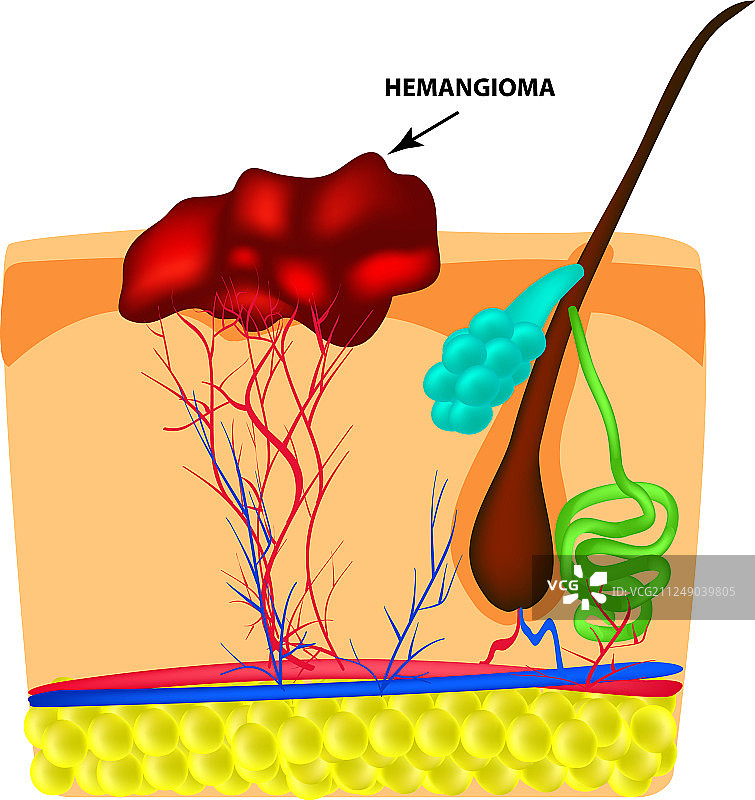 红色血管瘤结构图片素材