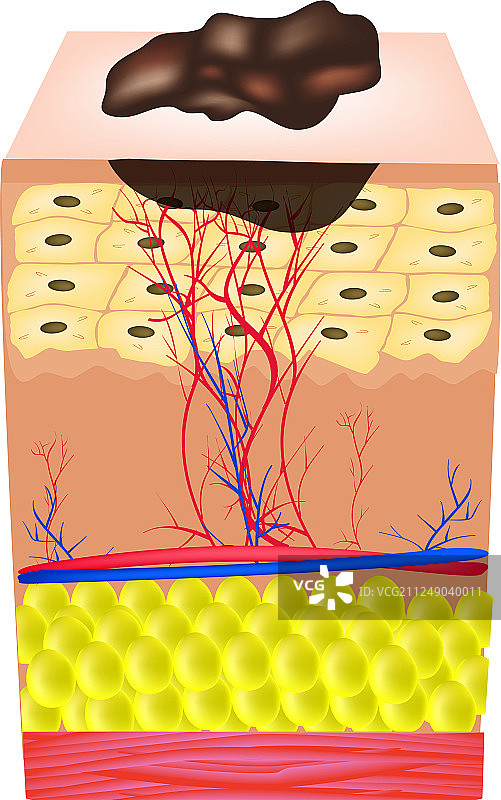 痣的结构图片素材