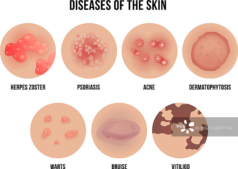 皮肤病类型皮肤科问题图片素材