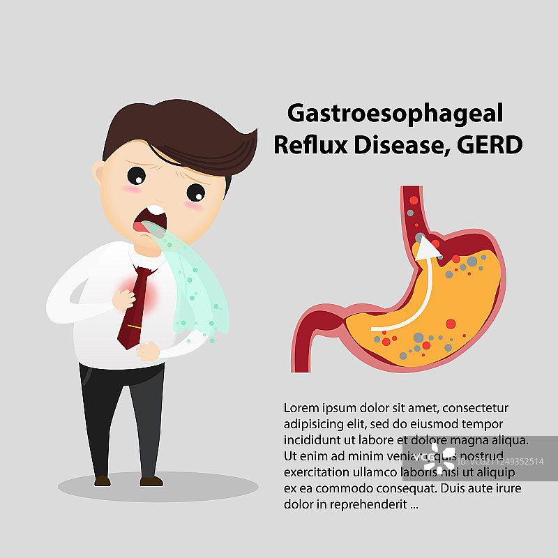 胃食管反流病图片素材