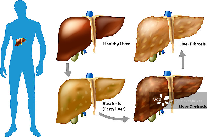 肝损伤的阶段图片素材