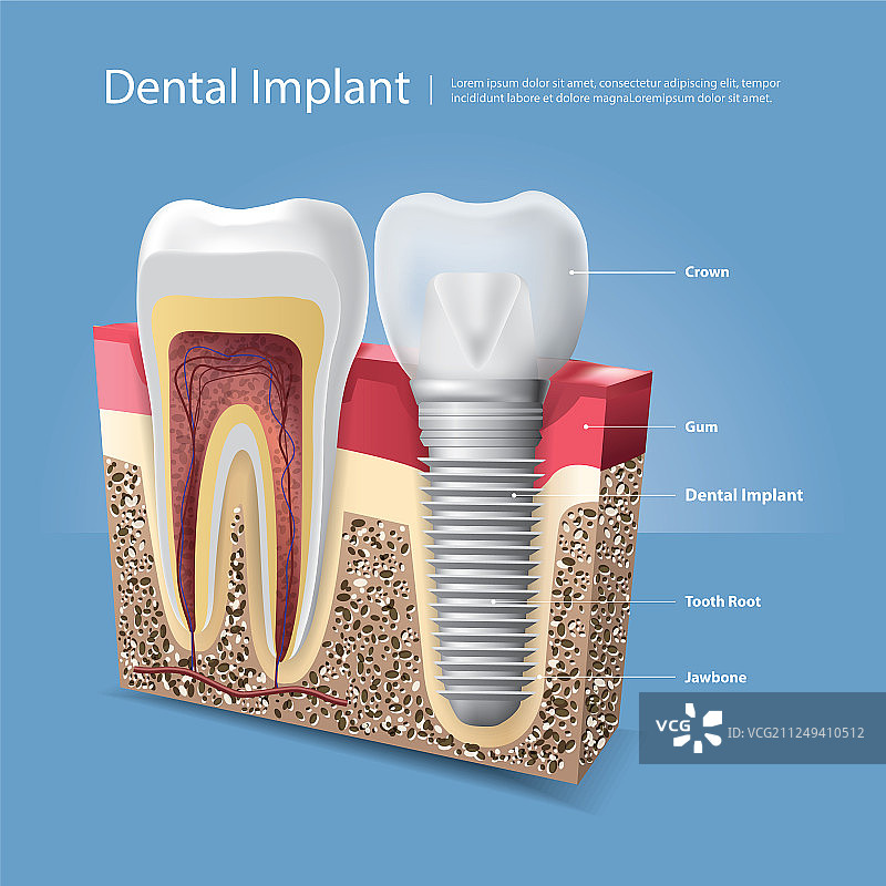 人的牙齿和牙科植入物图片素材