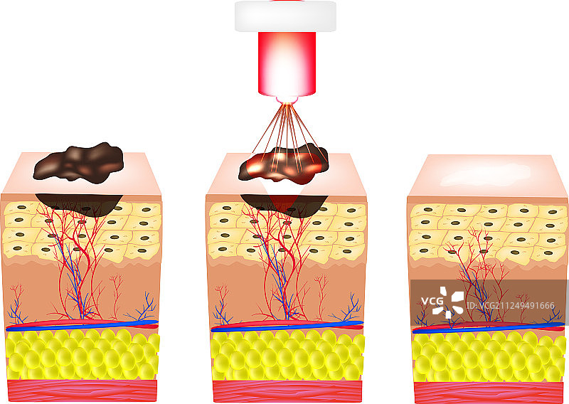 去除胎记、息肉、疣激光图片素材