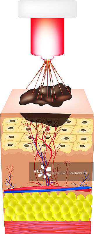 去除胎记、息肉、疣激光图片素材