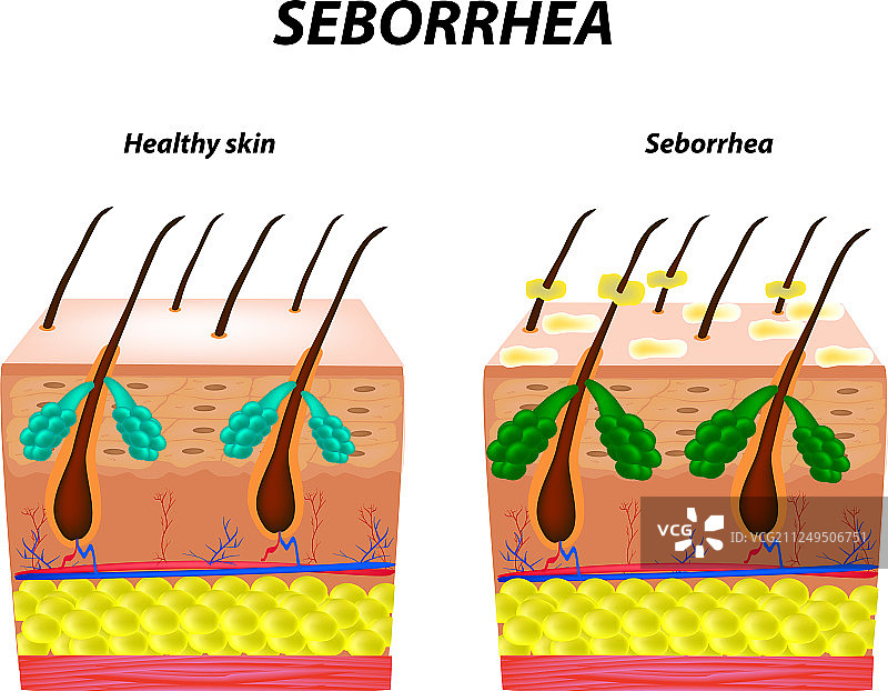 脂溢性皮炎皮肤和头发头皮屑图片素材