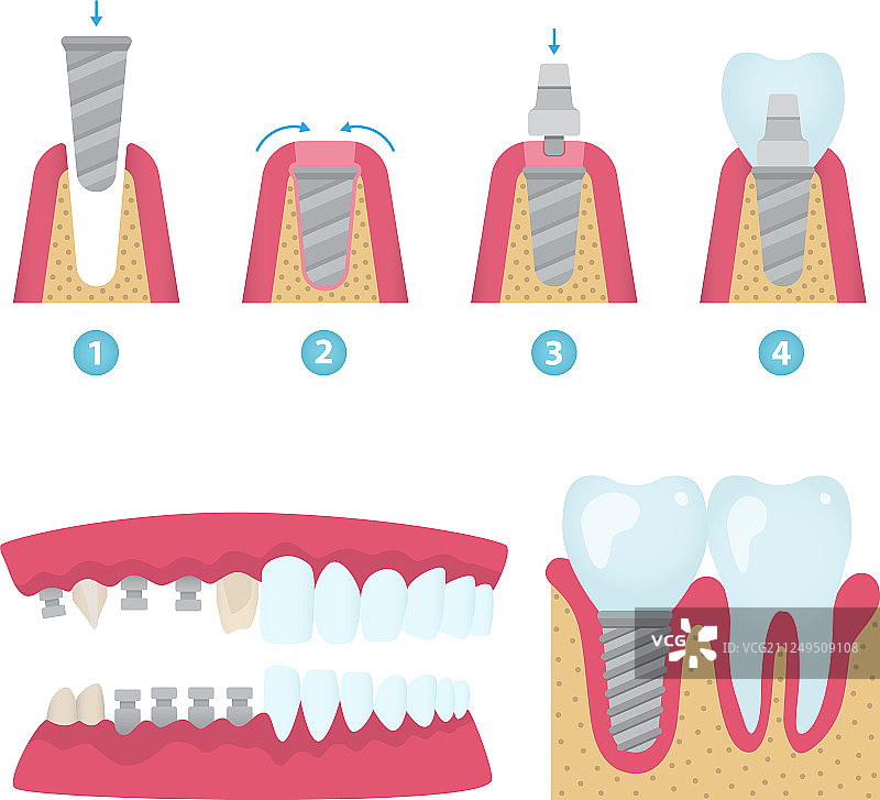 牙冠和种植牙图片素材
