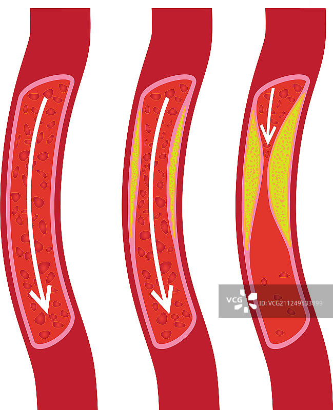 部分阻塞的健康血管图片素材