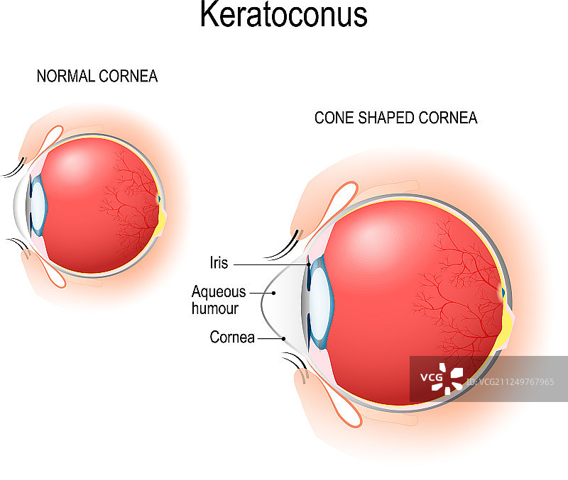 圆锥角膜、正常角膜和圆锥形角膜图片素材