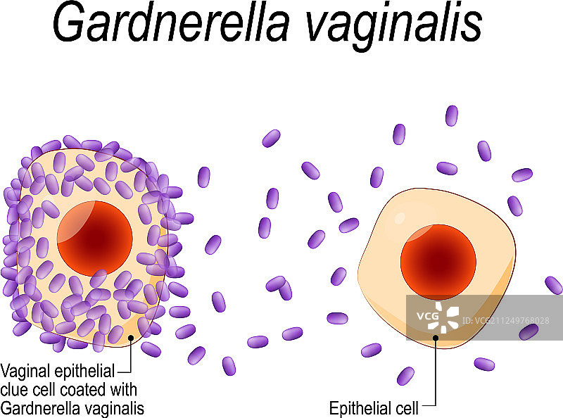 阴道加德纳菌阴道上皮线索细胞图片素材