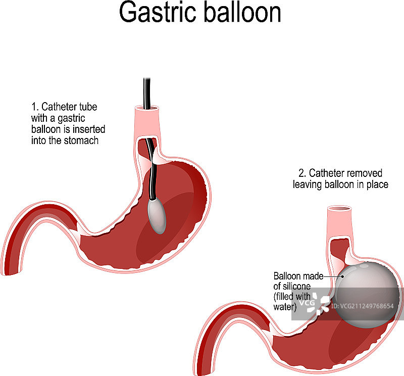 胃内球囊图片素材