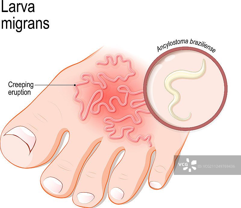 人体的皮肤幼虫移行症图片素材