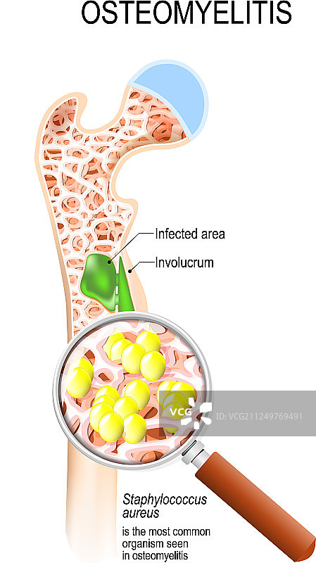 导致骨髓炎和细菌感染图片素材