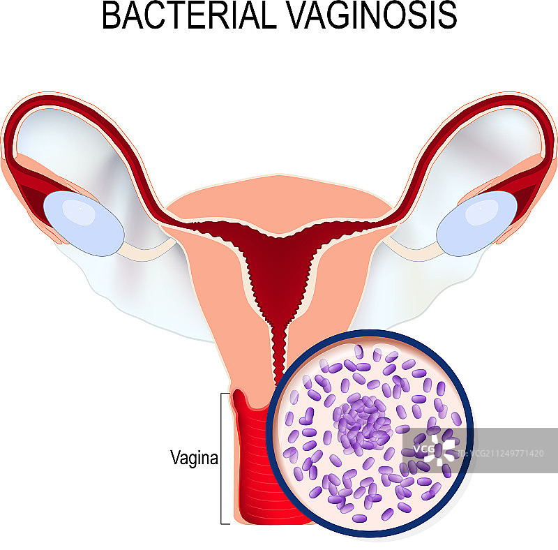 子宫与阴道加德纳菌特写图片素材