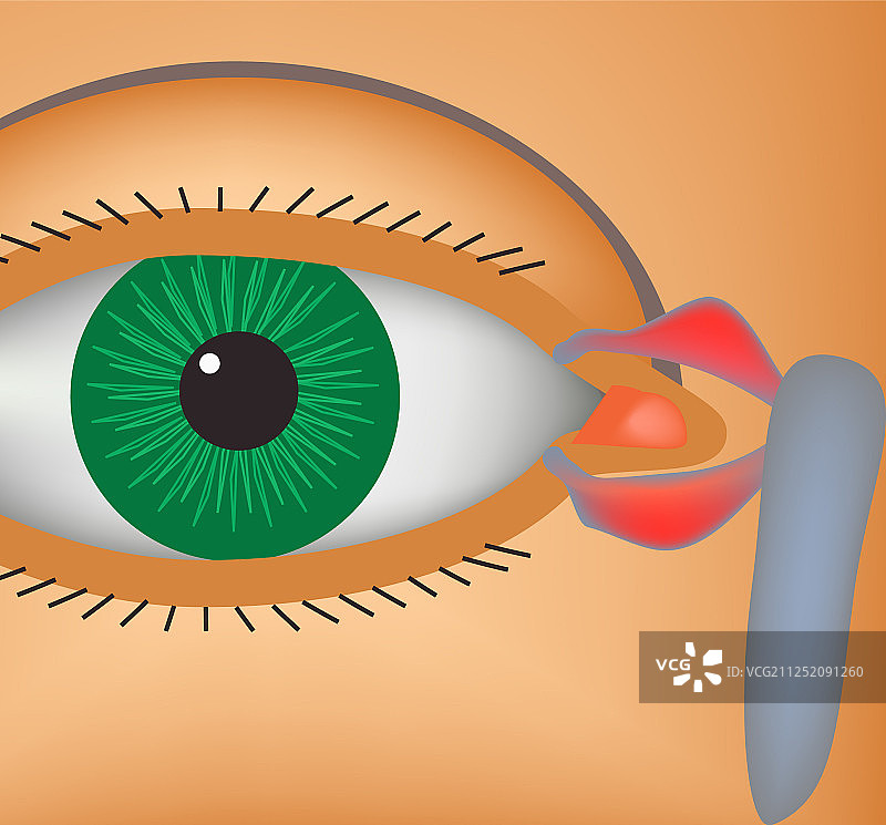 泪小管炎图片素材