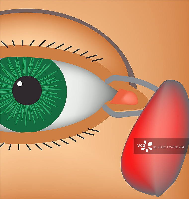 泪囊炎图片素材