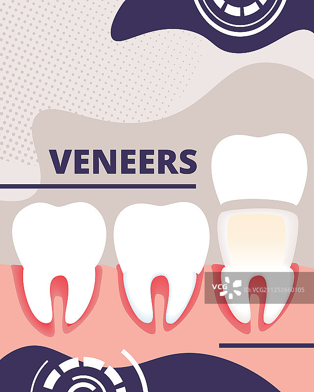 牙科贴面辅助banner信息图海报图片素材