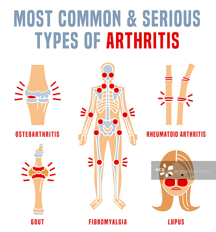 关节炎类型信息图图片素材