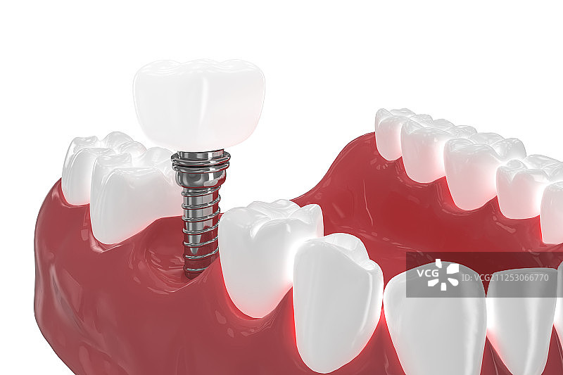 3D种植牙图片素材