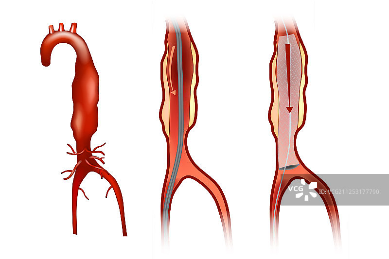 血管内动脉瘤修复图片素材